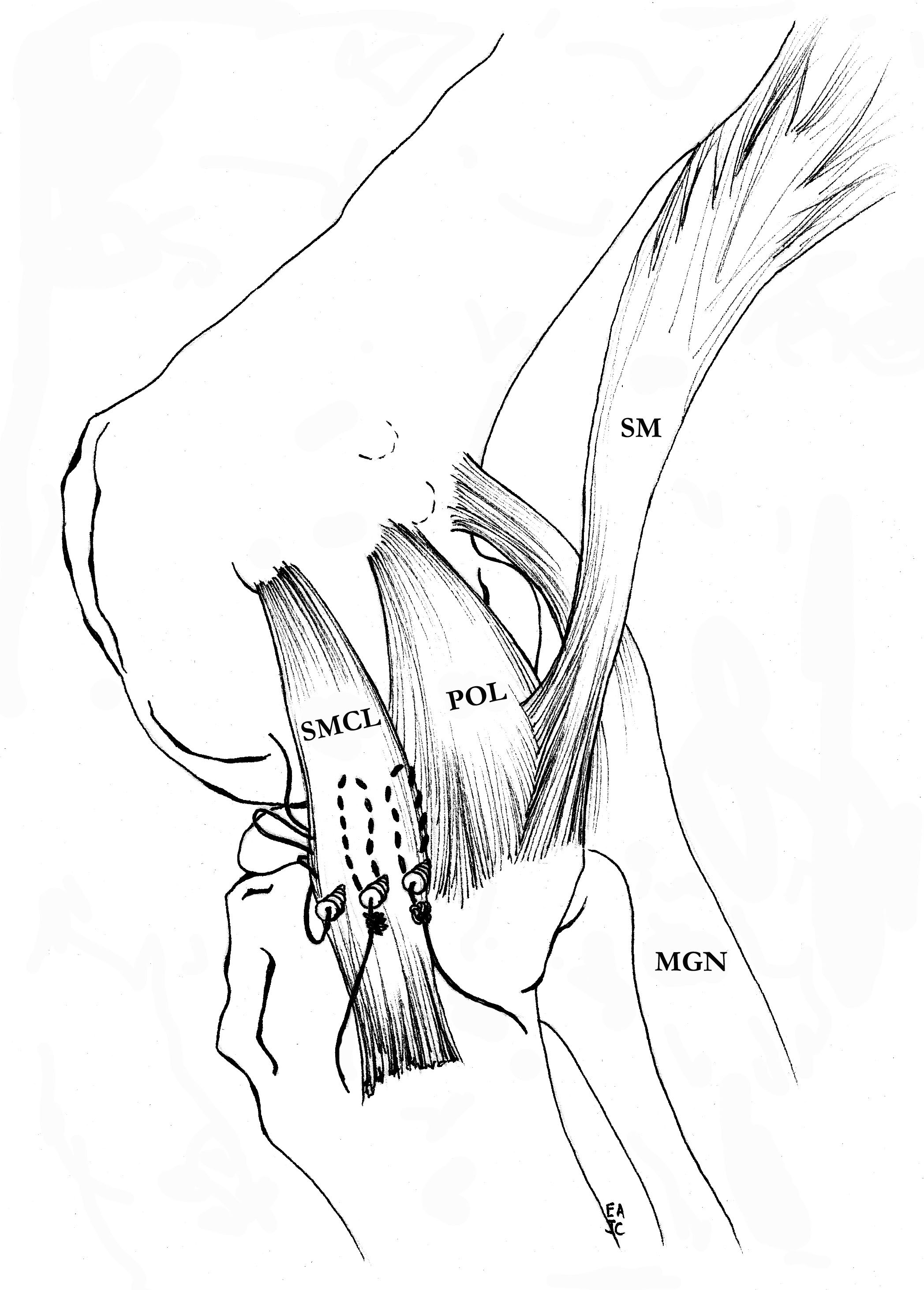 Distal Tibial Advancement 1